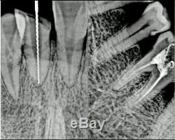 #dental Mobile #xray #generator #machine X-ray Appareil De L'unité Sans Fil Portable